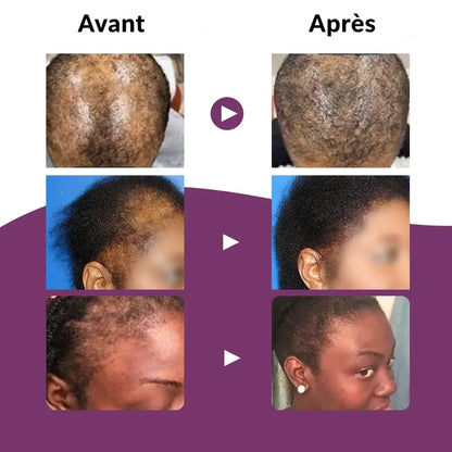 Gummies Vitaminées à la Biotine – Pour des Cheveux Forts, Épais et Brillants